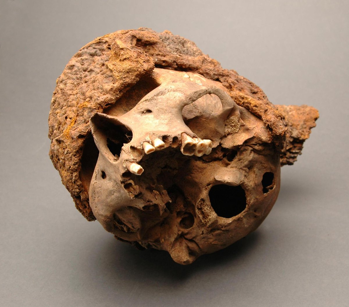 Remnants of a #Maille #Coif fused to the skull of a soldier killed at the battle of Visby on July 27th, 1361. Osteological estimates place this man between the ages of 30 and 35. Recovered from Mass Grave 2 near #Visby, #Gotland, housed at the @historiskamuse