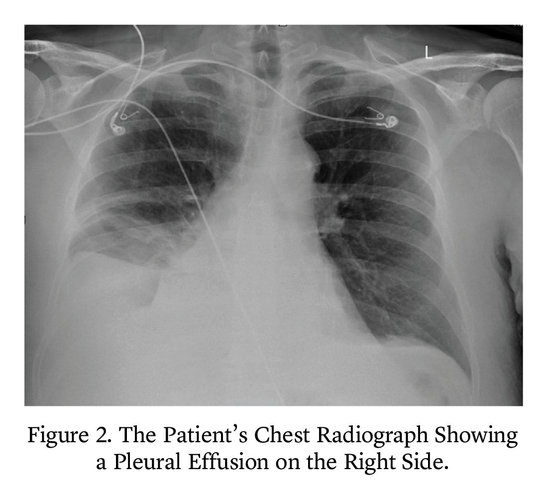 A 73-year-old man presented for evaluation of shortness of breath, weight gain, and leg swelling. A team from West Virginia University’s Camden Clark Medical Center reviews their approach to evaluating this patient in the latest Morning Report. eviden.cc/4b2w0vk @winroy_