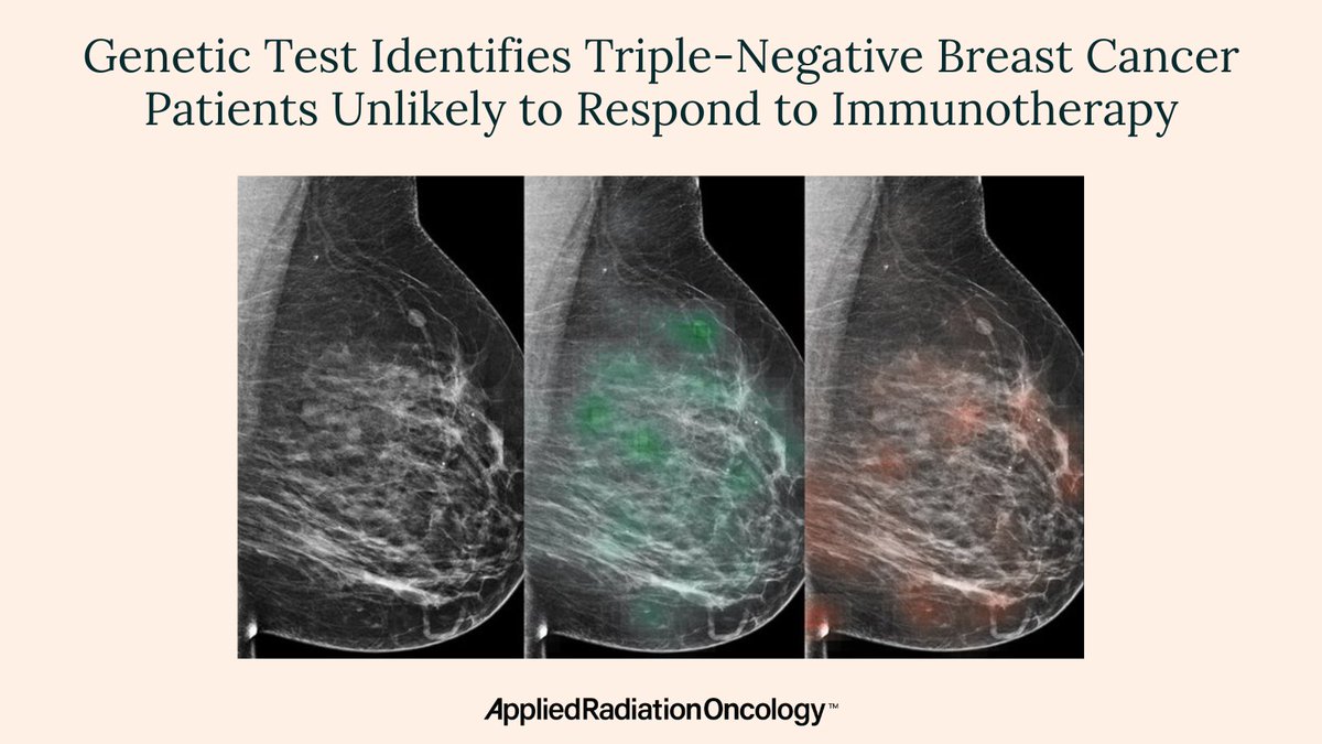 “It is increasingly appreciated that the ‘one size fits all’ approach is not optimal for the systemic treatment of patients with early triple-negative breast cancer.” Learn more ➡️ bit.ly/43xeUDr #RadOnc #RadOncEd #NWHW #BreastCancer #CancerTreatment #PatientCare