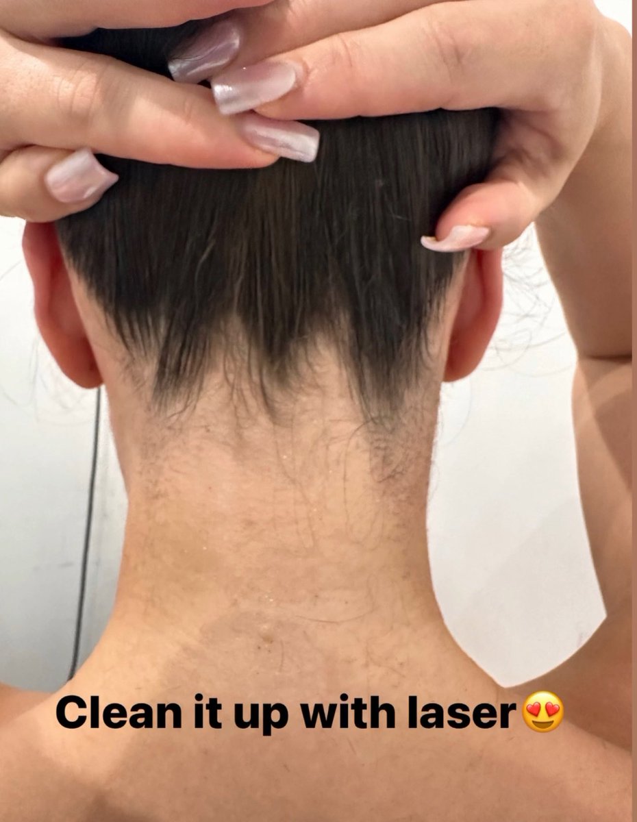 Laser Hair Removal for the win🤩

Love a nice neck line😍

#laserhairremoval #laser #hairremoval #neckline #hairfreecarefree #nohairdontcare #yag #ndyag #ndyaglaser