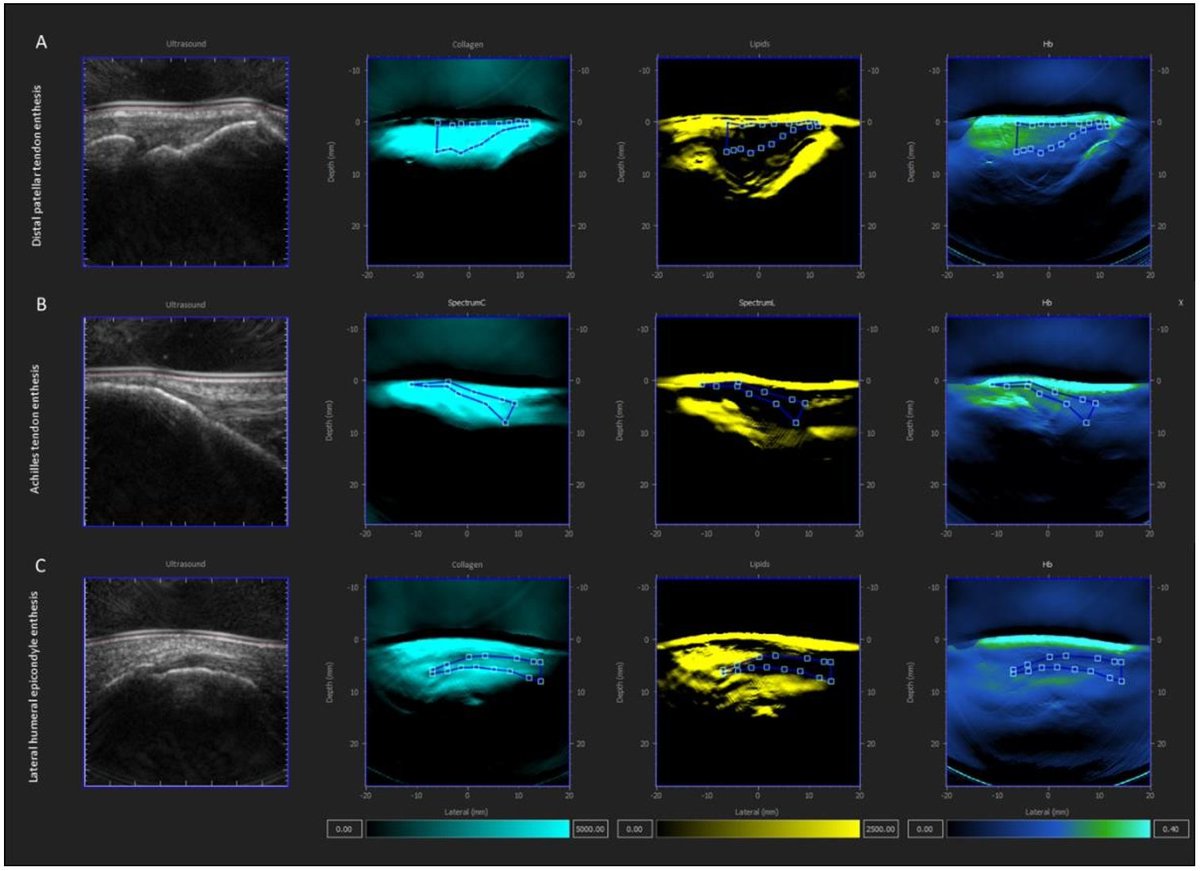 Exciting research unveils shared metabolic signatures within entheses comparing psoriasis, psoriatic arthritis pts & healthy controls via cutting-edge MSOT imaging, underscoring a spectrum of psoriatic disease In A&R loom.ly/iRLm10Q @KorayTascilar @dr_david_simon @FFagni