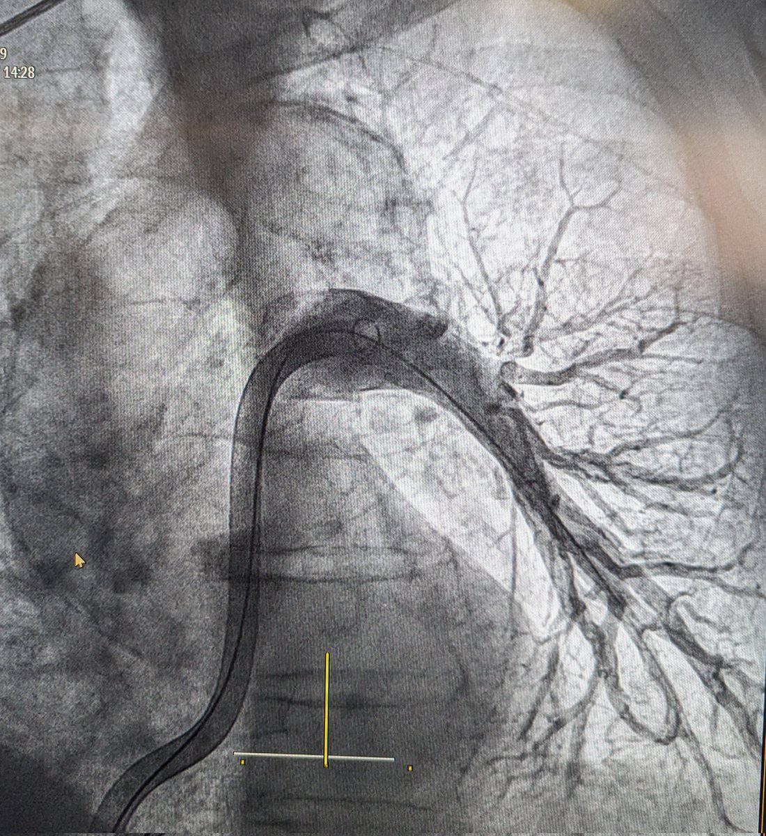 Happy coincidence! From academic discussion on Mechanical Thrombectomy for PE yesterday at #EuroPCR2024 to treating today a HBR patient with decompensated Interm.-high risk PE in <24h 🇨🇵 🎓 ✈️ 🇪🇦 🏥 🩻 @CuissetDr @InariMedical