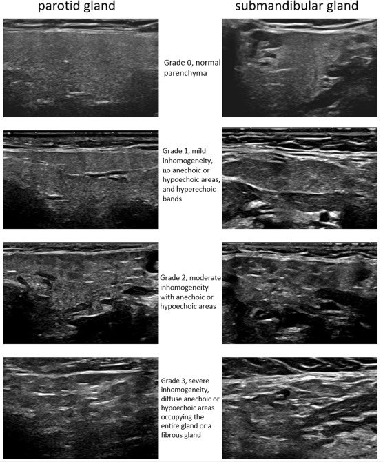 Dana DiRenzo, M.D. of <a href="/PennRheum/">PennRheum</a>  at the <a href="/USSONAR_Rh/">USSONAR</a> MULTI TRACK ULTRASOUND COURSE in her element teaching Salivary Gland #sjogrens ultrasound.  

As she says, “An easy, quick tool to assess disease activity in Sjogren’s Syndrome, but be cautious about lymphomas.”

#pocus #rheum