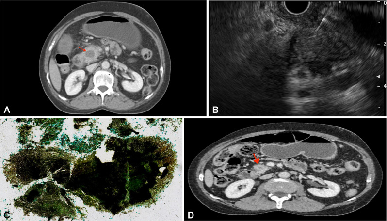 At the Focal Point, Katrevula et al discover a 'Pancreatic pseudotumor: serendipitous discovery of pancreatic actinomycosis.' giejournal.org/article/S0016-…