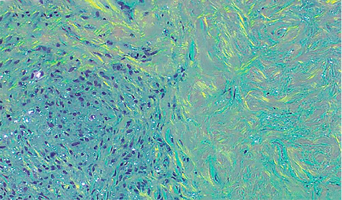 A 47-year-old man was incidentally found to have diffuse nodular opacities on chest radiography. He had worked in a quarry for more than 30 years. Read the full clinical case: nej.md/4bwq5Pc