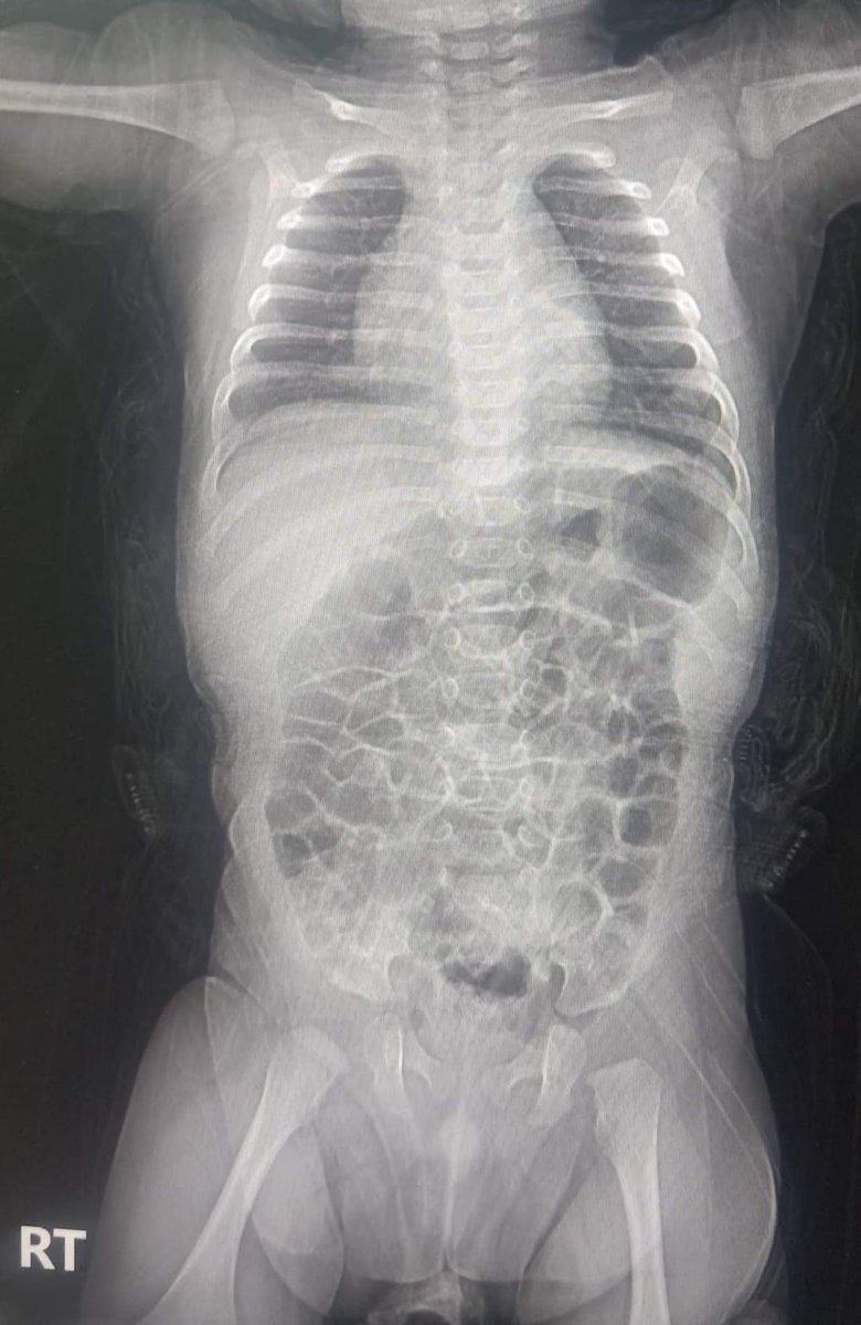 Bowel obstruction
hernia diaphragm