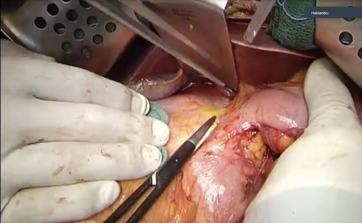 🎥 LIVE retroperitoneal #sarcoma surgery at #RESURGE @ESSOnews 🇮🇹 Milan: Right DDLPS @IstTumori 🇫🇷 Paris: Left DDLPS + pancreas Ca @institut_curie 🇳🇱 Amsterdam: Pelvic LMS @NKI_nl Amazing surgical detail in critical steps! Looking forward to ➡️ edition