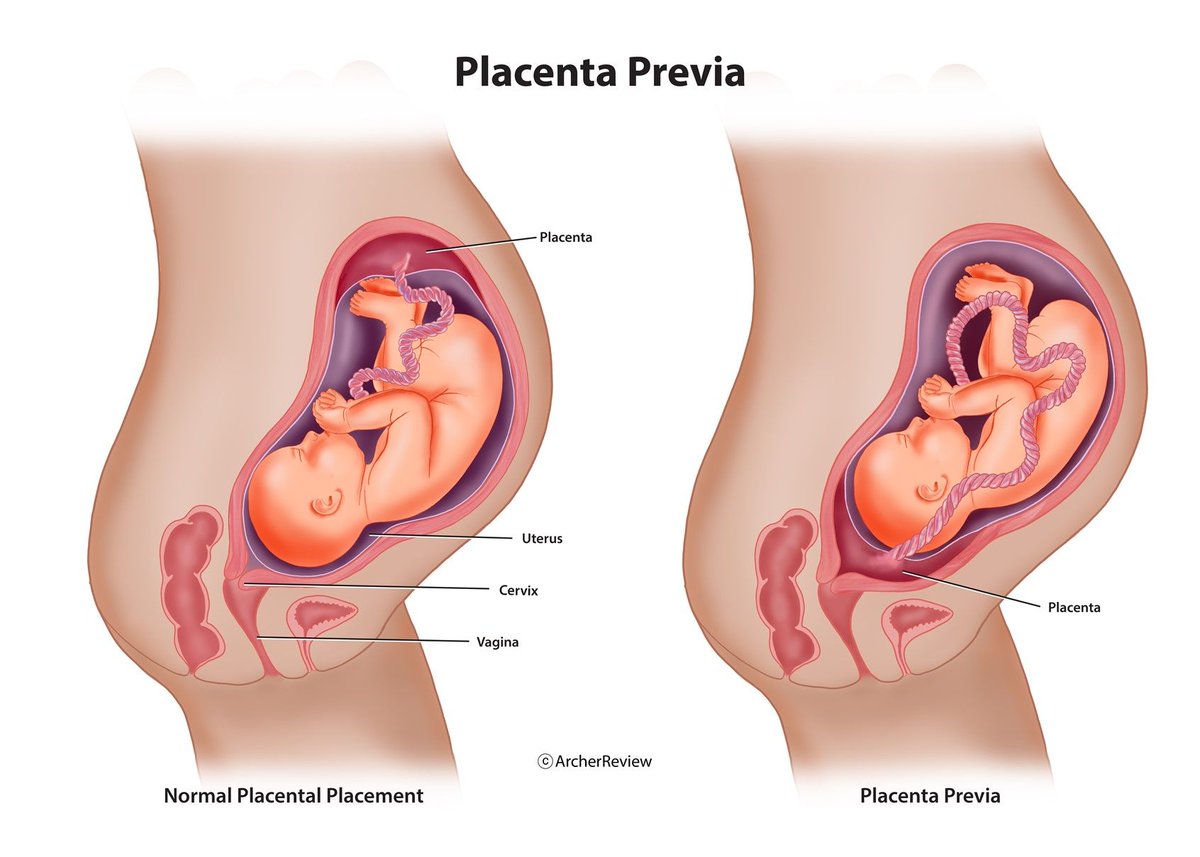 Placenta Previa, illustrated by Suzanne Hayes. Explore more of her work: buff.ly/3eWxsSm #placentaprevia #placenta #embryo #fetus #pregnancy #obstetrics #gynecology #patienteducation #anatomy #medical #illustration #medicalillustration #scientificillustration #sciart