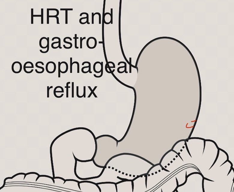 Gastroesophageal reflux disease (GERD) is a chronic condition associated with several risk factors. Common symptoms include heartburn, difficulty swallowing, and chest pain. Does menopausal HRT use affect the condition? pubmed.ncbi.nlm.nih.gov/37369078/ pubmed.ncbi.nlm.nih.gov/35151861/