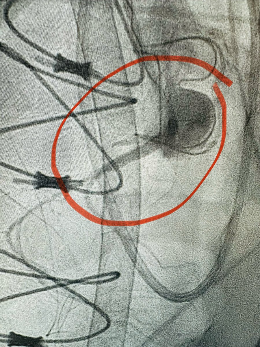 Non-dominant RCA: not always “benign”. RV failure and inability to wean off ECMO post-valve/Ao surgery: with rapid normalization of RV function and follow-on ECMO decannulation after successful PCI to non-dominant RCA…