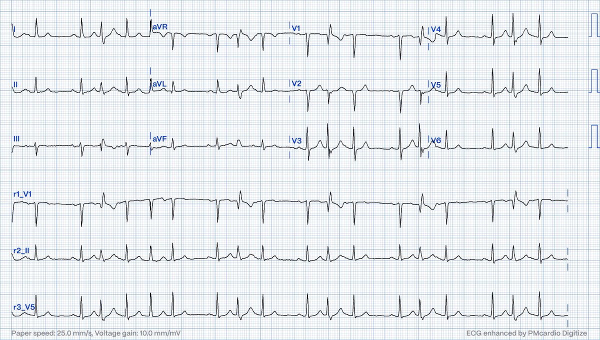 Rhythm? @akneton @yolyabreuh @UlhasDr @DidlakeDW @ecgrhythms @syamkumarmd @IhabFathiSulima @DocNikko @DrPharmDMDTh @Vadeboncoeur_Al @EF_Cardiaca @smithECGBlog @EM_RESUS @estudiomedicina @OrlandoRPN @fxgodzeuss #EPeeps #Cardioed #FOAMcc @ResusMed @Sthanu5 @MattersoftheH14 @TrRja