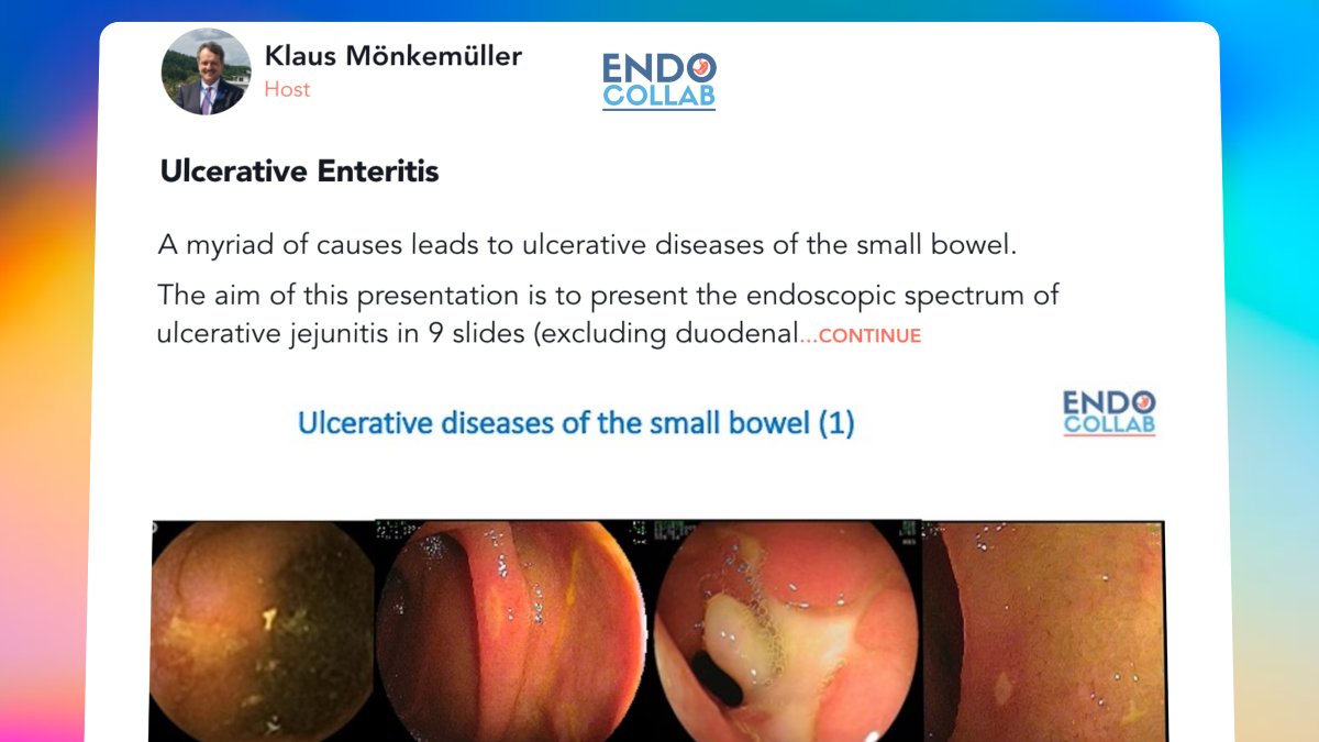 Ulcerative Enteritis New presentation on EndoCollab 9 Slides to present the endoscopic spectrum of ulcerative jejunitis (excluding duodenal conditions). A myriad of causes leads to ulcerative diseases of the small bowel. [Link] community.endocollab.com/posts/ulcerati…