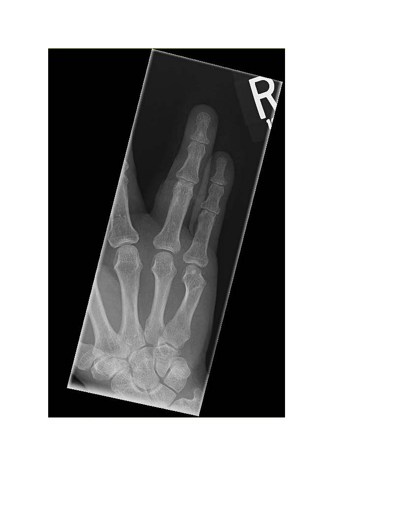 𝘾𝙖𝙨𝙚 𝙤𝙛 𝙩𝙝𝙚 𝙒𝙚𝙚𝙠 from Dr. Jing Jing Gong of Northwell Health PCSM Fellowship A 70 yo 🎾 player presents after a fall and 🖐️ injury. He can't flex or extend the 4⃣th digit. He has a lac proximal to the volar PIP. Which tendon is injured? shorturl.at/iPfjf