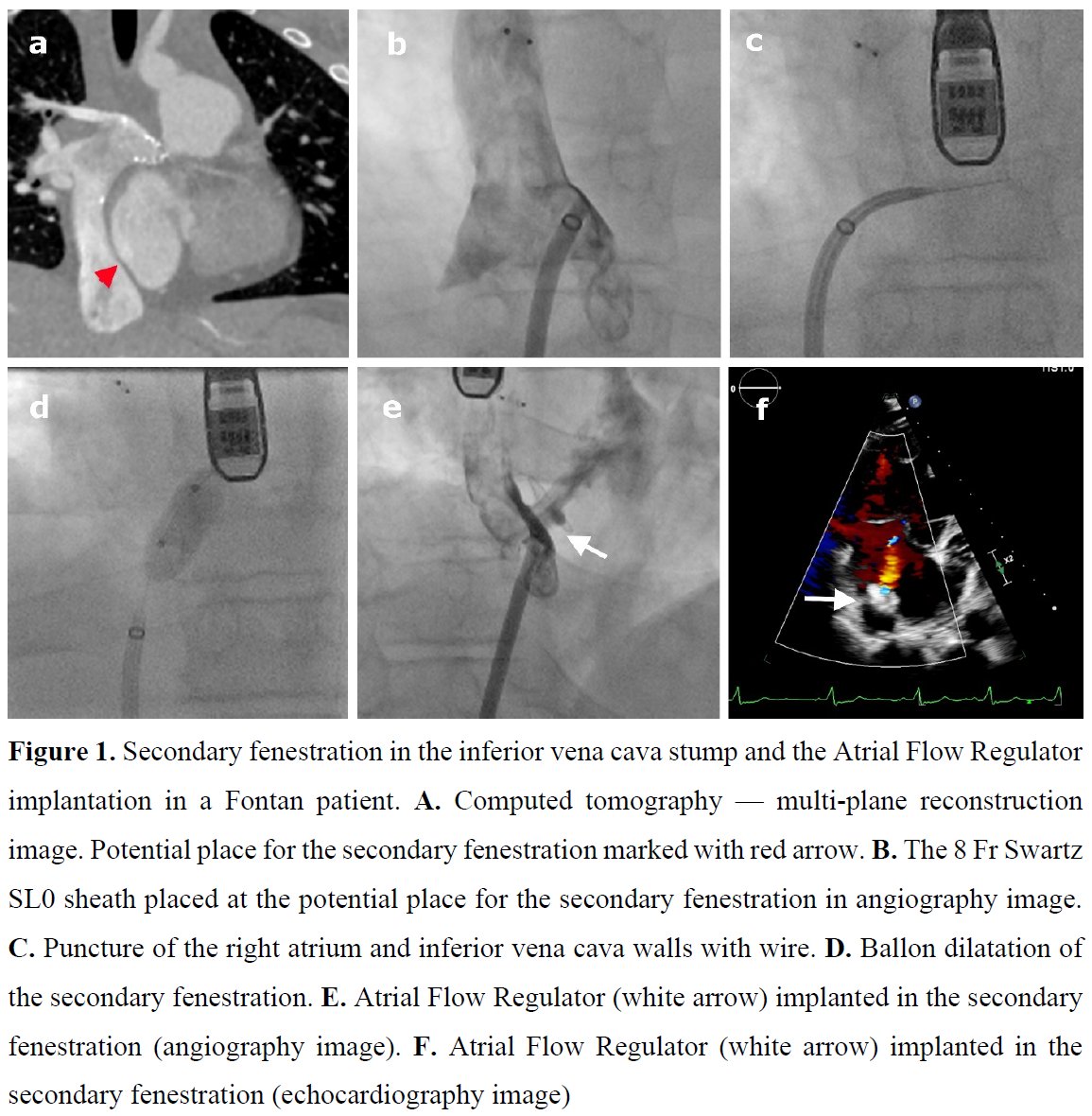 Editors' Insights: Creation of the secondary fenestration in the inferior vena cava stump with the occlutech atrial flow regulator implantation in a #Fontan patient. tiny.pl/ddkvd #PolishHeartJournal #CardioTwitter #HeartNews #Cardiology @PUMS_tweets