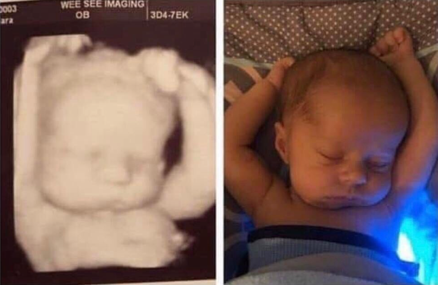 Same baby, different location. This sonogram shows this baby kept an old habit.