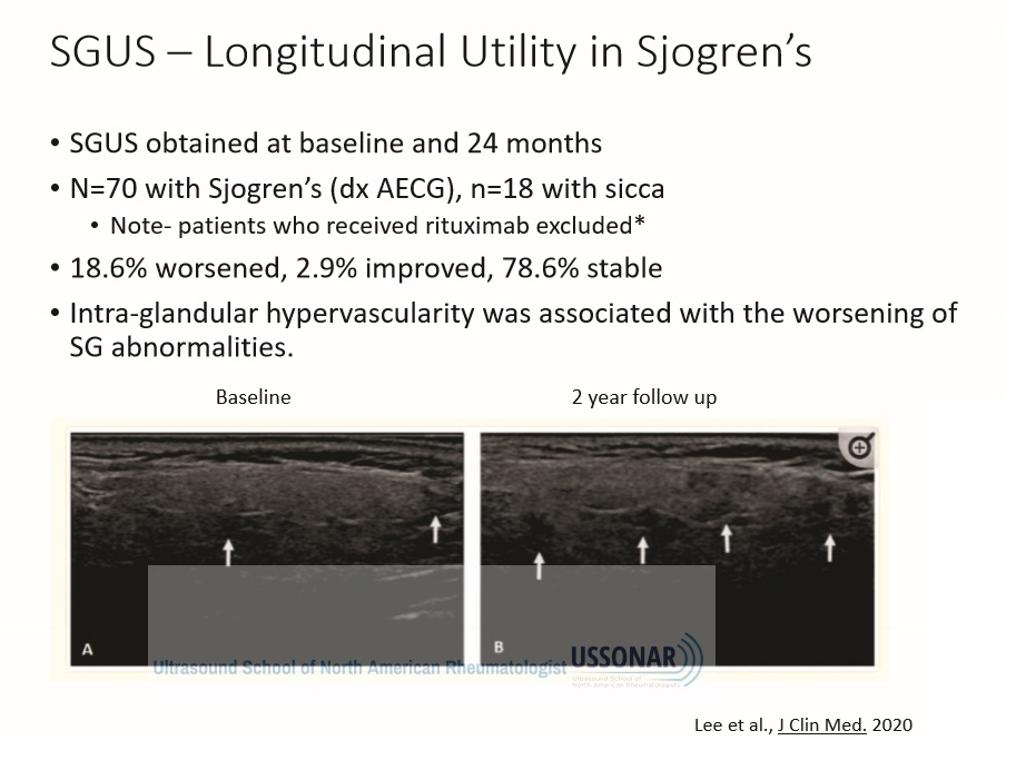 <a href="/danaddirenzo/">Dana DiRenzo</a> <a href="/PennRheum/">PennRheum</a> presents on the use of #Ultrasound in salivary glands #Sjogrens
US has utility on longitudinal assessment!

#RhUS #RhMSUS