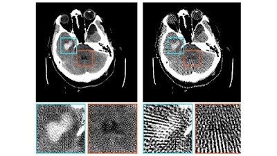 U-Net based artifact reduction substantially enhances automated hemorrhage detection in sparse-view cranial CTs doi.org/10.1148/ryai.2… @MIBE_TUM #DeepLearning #CTRad #AI