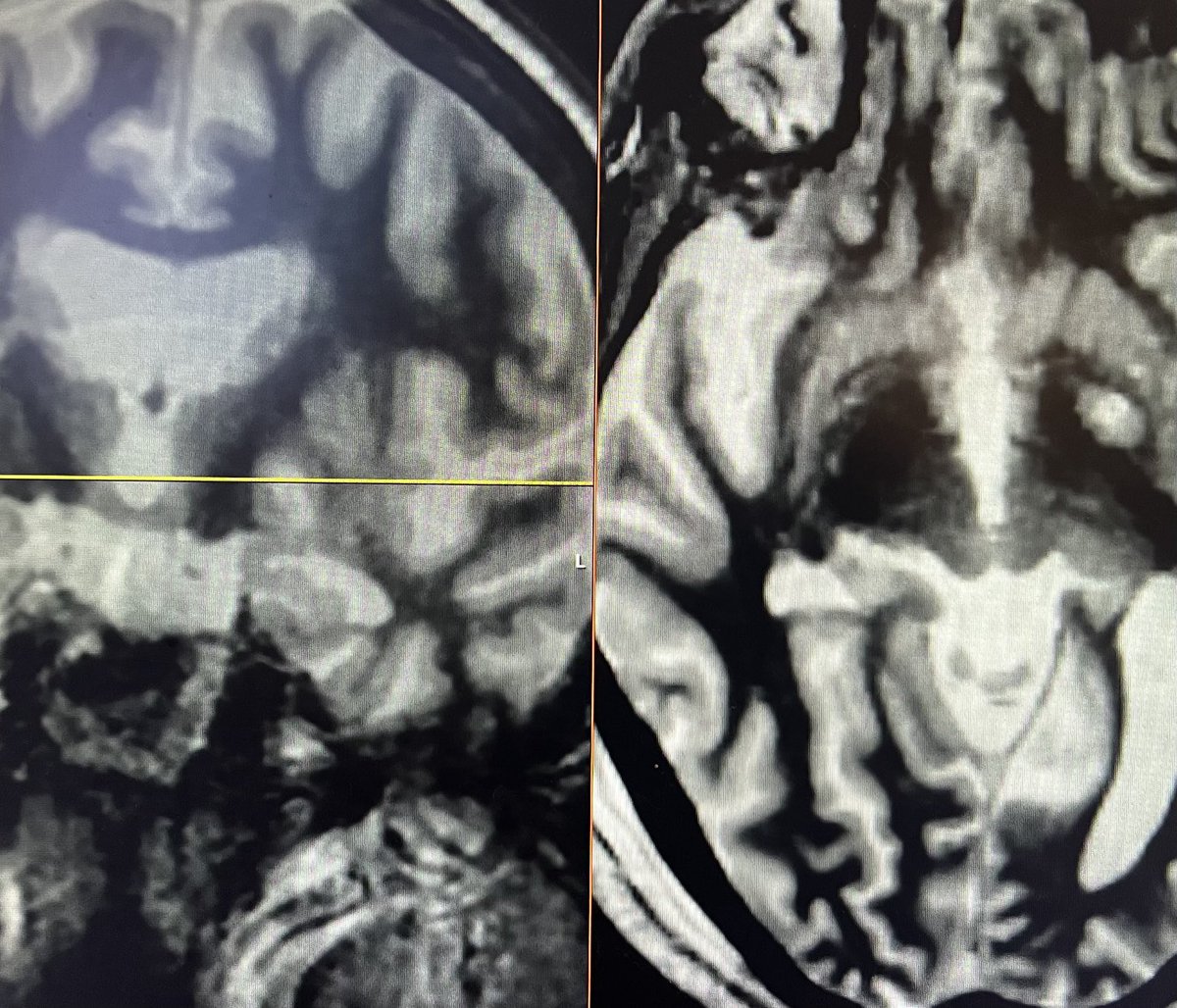 CaseyHalpern5's tweet image. Beautiful #focusedultrasound pallidotomy for Parkinson’s. Thrilled to offer this treatment at Penn. Magical effects when the patient is well-selected.