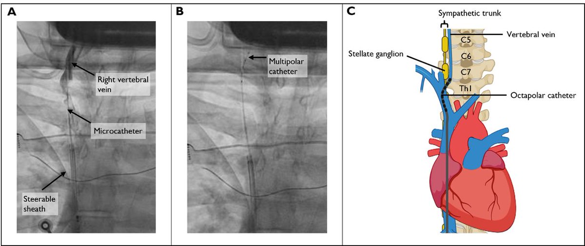 Timothy Markman (@dr_markman) on Twitter photo <a href="/MichaelGurinMD/">Michael Gurin</a> <a href="/HRSonline/">Heart Rhythm Society</a> Very excited to share the work presented by <a href="/adrian_petzl/">Adrian Petzl</a>, simultaneously published in @JACCjournals. He describes a PAC ablation limited by infrequent intraprocedural PACs. With direct, intravascular electrical sympathetic stimulation, PACs were induced and ablation facilitated. <a href="/MichaelGurinMD/">Michael Gurin</a> <a href="/HRSonline/">Heart Rhythm Society</a> Very excited to share the work presented by <a href="/adrian_petzl/">Adrian Petzl</a>, simultaneously published in @JACCjournals. He describes a PAC ablation limited by infrequent intraprocedural PACs. With direct, intravascular electrical sympathetic stimulation, PACs were induced and ablation facilitated.