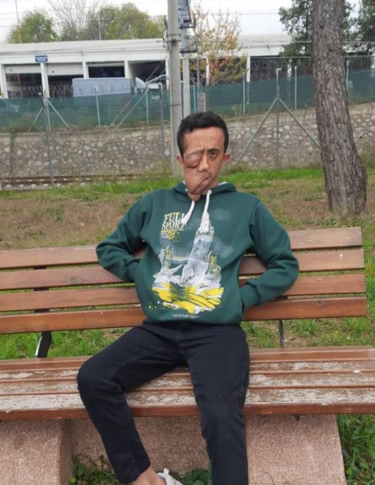 Haluk abi,nörofibromatozis hastası İsmail abim yardımınızı bekliyor babası da aynı hastalıktan dolayı yatalak hasta.İsmail abinin acil yüz ameliyatı olması gerekiyor çok zor durumdalar benim hayatımı değiştirdiniz ona da el uzatır mısınız?Tek hayali gülmek ve görmek🙏🏻<a href="/haluklevent/">Haluk Levent ( Ahbap Ekibi )</a>