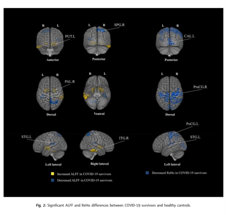 Study using rs-fMRI reported brain function changes in various regions that could be contributing to the persistent and long-term cognitive complaints experienced by #LongCovid patients - 2 years after infection msn.com/en-gb/health/o…