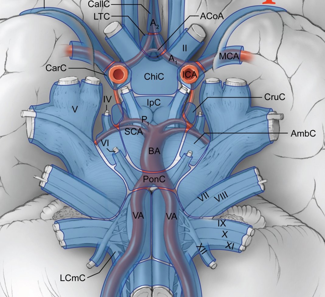 Watch the Seven Series video showing this R pterional craniotomy, clipping of incompletely coiled, ruptured middle cerebral artery aneurysm, on our website @BarrowNeuro by clicking on this link…Bar.rw/7series