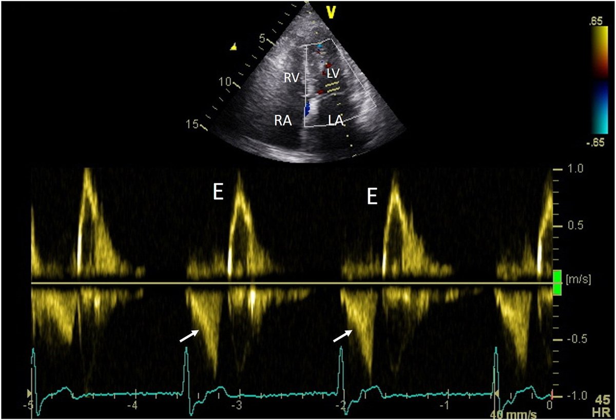 Here is a @CASEfromASE of junctional rhythm with retrograde P waves, which cause fascinating Doppler flow profiles due to an abnormal atrial electrical activation, leading to an atrial mechanical contraction and relaxation during ventricular systole. bit.ly/44LDaSI