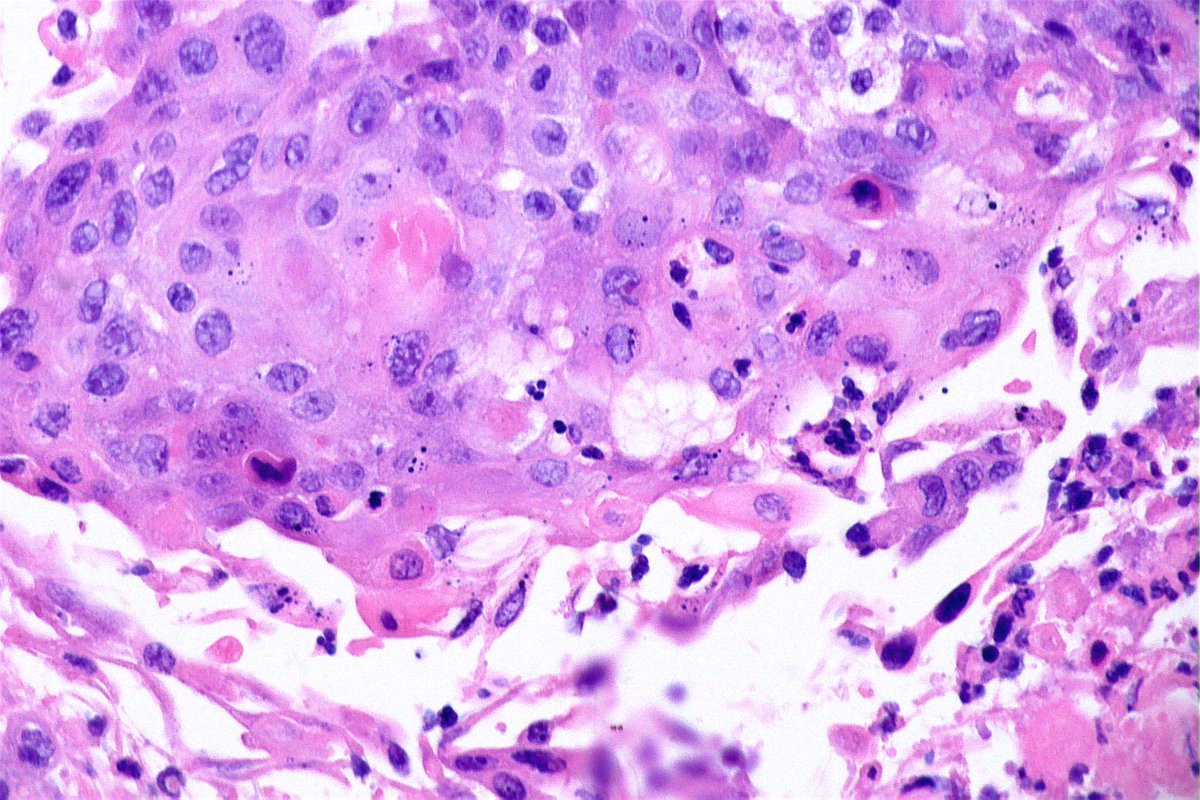 FNA-EUS Carcinoma with extensive squamous differentiation in the PANCREAS and an adenoca component. Squamous differ is uncommon in pancreatic ca and usually occurs + conventional ductal adenoca. DDX: Adenosquamous carcinoma (if squamous ≥ 30% of the neoplasm in surgical sample)