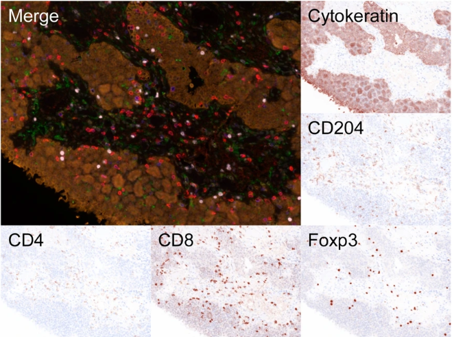 What makes for a good prognosis for those with muscle-invasive #bladdercancer? Japanese researchers used #spatialbiology to characterize the immune cells & TME in patients after cystectomy & neoadjuvant chemo. go.nature.com/44P3k75 #FridayRead #BladderCancerAwarenessMonth