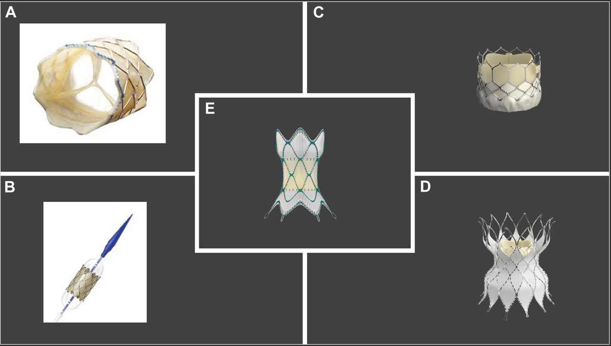 JACCJournals's tweet photo. 📢🔬 Exciting findings in #JACCINT! Learn about transcatheter interventions for tetralogy of Fallot across all age groups! 🧒👨‍🦳 Review covered palliative procedures like PDA &amp; RVOT stenting, &amp; balloon pulmonary valvuloplasty, &amp; others! 🫀 https://t.co/dn2UMEZZvb https://t.co/uJzYSyxYgp