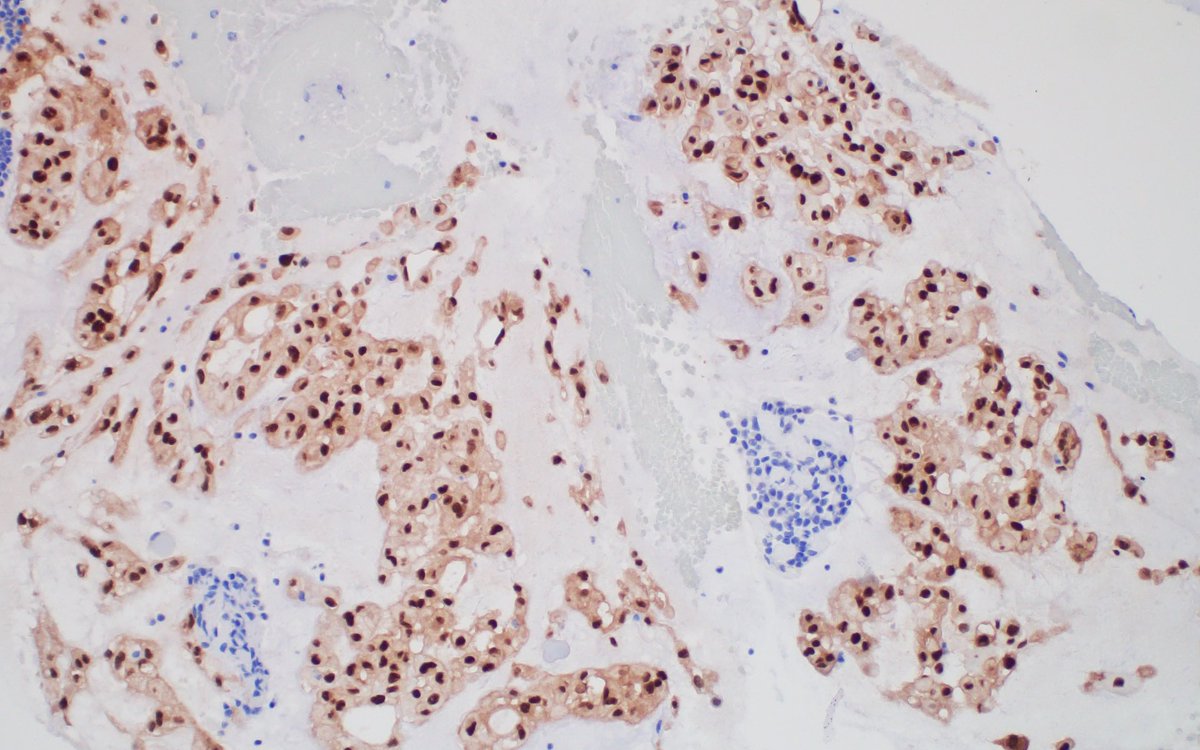 Clivus mass 

Note the bubbly cells and blue tinged matrix 

1. Watercolor on paper 
2. H&amp;E
3. Brachyury

What is the diagnosis?
Chondroid chordoma

What are the bubbly cells? Physaliphorous cells 

#ocularpathology #aao2024 #neuropathology #aanpneuropathology #aaoeye
