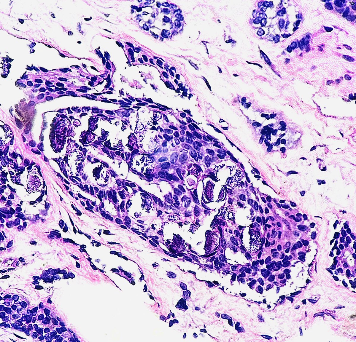 Complex Fibroadenoma 

Needs one or more:

1) Cysts greater than 3 mm
2) Epithelial (not stromal) calcifications (see below)
3) Papillary apocrine Metaplasia
4) Sclerosing adenosis

⬆️ relative risk ~ 3x for breast cancer (citation 👇)

#pathagonia #path4people #pathx #breastpath