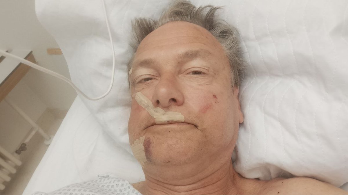 unblogd's tweet photo. Michael #Stürzenberger meldet sich zu seinen Verletzungen:

»Es war richtig knapp gestern. Gerade kamen vier Ärzte zur Visite. 

Lebensgefährlich hätte der Stich seitlich in die Brust werden können, der Richtung Lunge ging.

Der Stich in den Oberschenkel traf Venen und verursachte erheblichen Blutverlust. Es gab noch einen zweiten Stich ins Bein oberhalb des Knies, glücklicherweise ohne  die Sehne zu verletzen.

Die Verletzung am Oberarm ist verhältnismäßig glimpflich.

Anders die Stiche ins Gesicht. Ich habe Klammern im seitlichen Kiefer. Die Oberlippe wurde genäht, ich hatte eine klaffende offene Wunde bis zu den Zähnen.

Einen großen Dank an alle Ärzte und die Gesichtschirurgen, die extra von einer Spezialklinik kamen.

Was ein einzelner afghanischer "Flüchtling" mit einem Messer alles anrichten kann..«

cc stuerzenberger | Telegram
Folgt @MichaelStuerzi