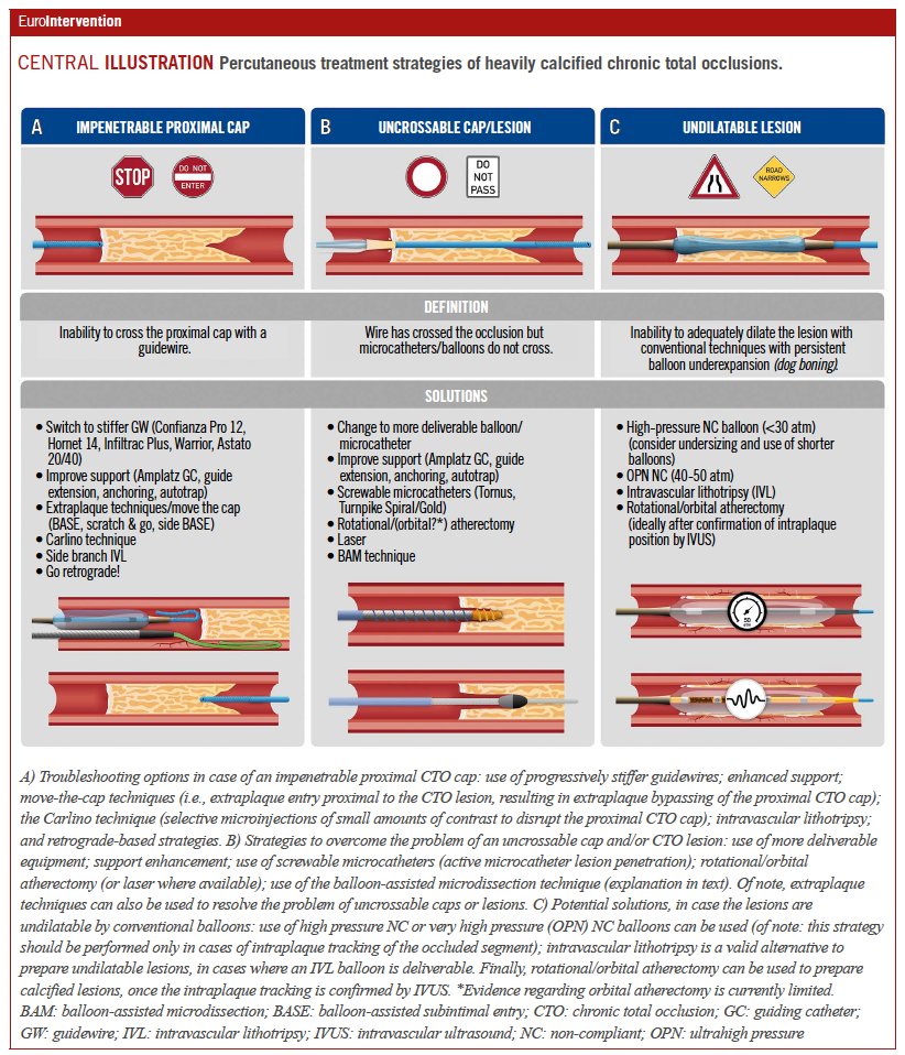 Contemporary issues of percutaneous coronary intervention in heavily calcified chronic total occlusions: an expert review from the European CTO Club. #EIJBestOf ow.ly/8qaG50OGpNo
