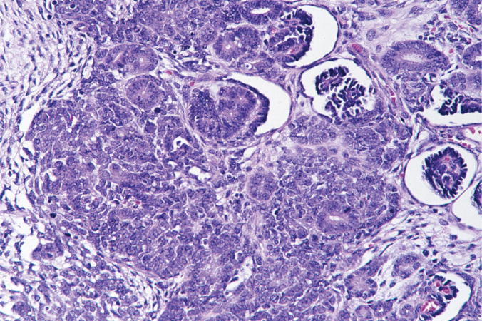 More the the bladder/kidney fascicle (arppress.org/books/book/45):
Nephroblastoma (Wilms tumor) is a malignant embryonal neoplasm and the most common pediatric renal neoplasm, classically composed of blastemal, stromal, and epithelial elements.
#GUpath #pedipath