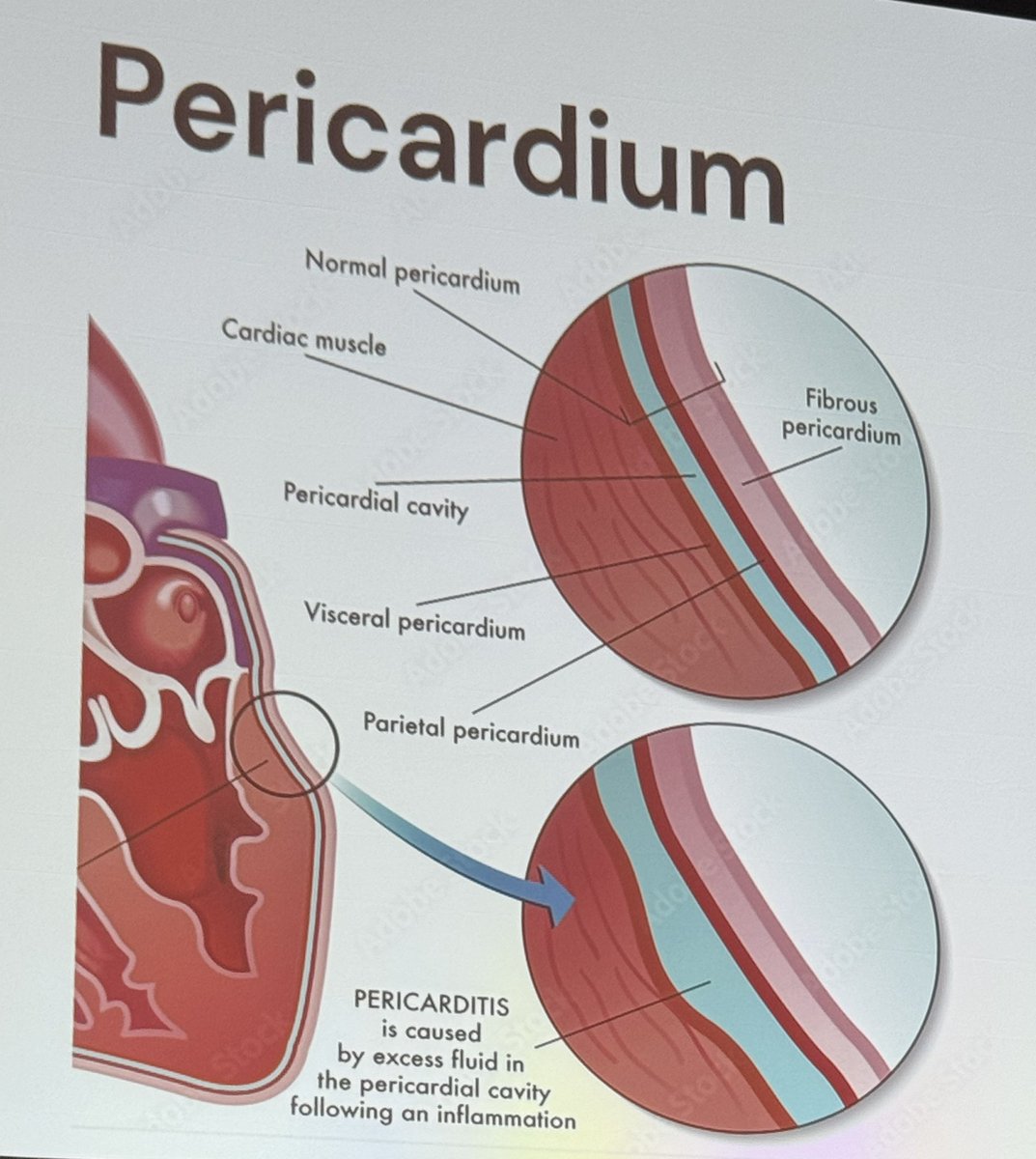 Nidhi Patel (@nidhihpatelmd) on Twitter photo Day1 of #ESCAPE2024 with Dr. <a href="/DannyEapenMD/">Danny Eapen</a> talk on Pericarditis🫀🧵(1/7)
We start with a review of the pericardium composed of:
1.Fibrous pericardium
2.Serous pericardium —> parietal and visceral
Pericarditis: 💦fluid between parietal-visceral after ⚡️inflammation Day1 of #ESCAPE2024 with Dr. <a href="/DannyEapenMD/">Danny Eapen</a> talk on Pericarditis🫀🧵(1/7)
We start with a review of the pericardium composed of:
1.Fibrous pericardium
2.Serous pericardium —> parietal and visceral
Pericarditis: 💦fluid between parietal-visceral after ⚡️inflammation