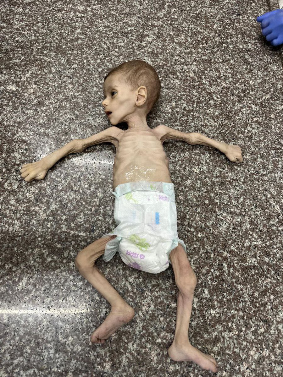 The child Fayez Abu Ataya was martyred this morning Due to malnutrition and the lack of treatment.