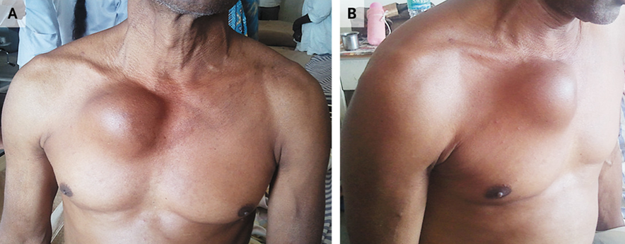 guerreroespejo's tweet photo. 45 años♂️, #sífilis no tratada: tumefacción pulsátil en el lado derecho del tórax desde hacía 3 meses (A y B).

Eco: regurgitación aórtica leve con aneurisma de la aorta ascendente.
1/3

DOI: 10.1056/NEJMicm1215039
#infecciosas #microbiología https://t.co/dCuVjNmm8G