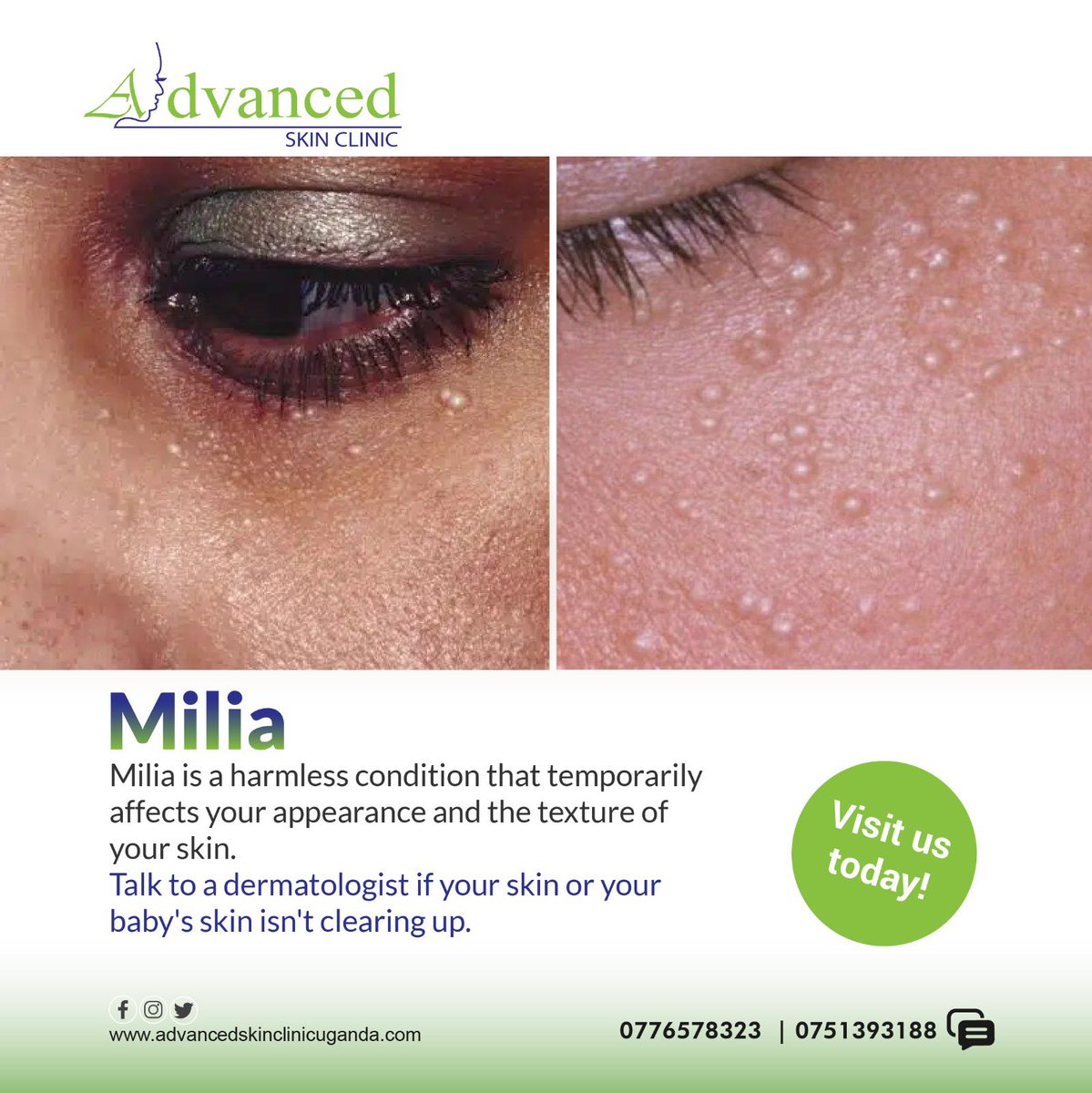 Talk to a dermatologist if your skin or your baby’s skin isn’t clearing up within a few weeks.
#skintreatment #milia