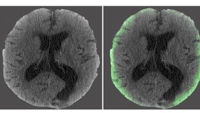 Semisupervised learning achieved stronger generalization for intracranial hemorrhage classification and segmentation on head CT doi.org/10.1148/ryai.2… @UCSFimaging #NeuroRad #ICH #MachineLearning