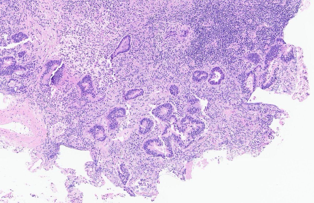 bedi_begui's tweet photo. Slow-growing lesion in the lung (3 cm, was present since 2021) 🫁
I don't see clear signs of invasive carcinoma (too cystic?)
What do you think about the term "lung adenoma with enteric morphology"?
@SansanoValero @lara_pijuan @tlabiano @Histopatolomon @DrCycloPath Thx💗💙💛 https://t.co/Rkn9eGL7B1