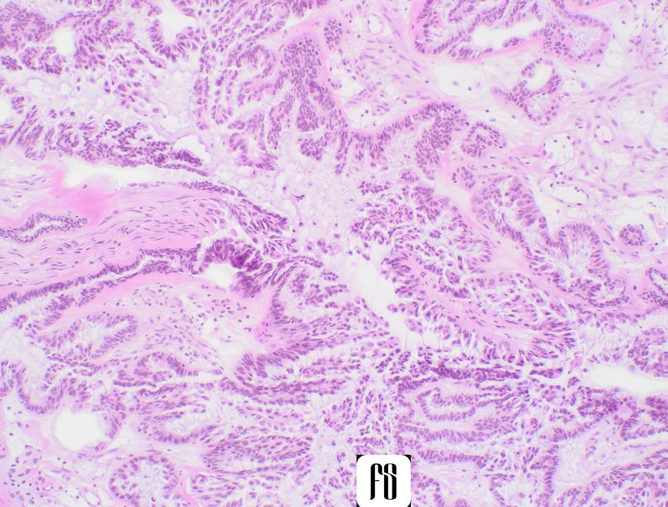 👉Intra-op Frozen case:
27YO female with right adnexal mass.
How will you word your report in this case?

Courtesy @annsmiley78 

#gynpath #PathTwitter #pathologist #surgpath