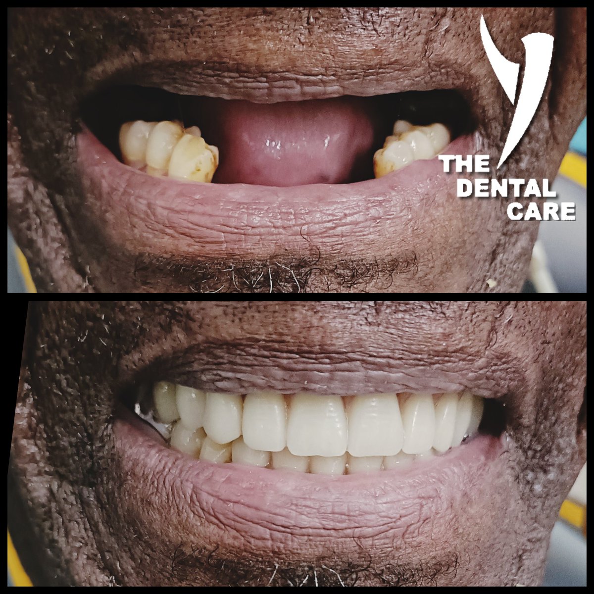 The Dental Care provides quality dentures for the elderly? Look no further! Our clinic can make dentures tailored to meet your needs. Say goodbye to missing teeth and hello to a comfortable smile. #Dentures #ElderlyCare #DentalHealth'sekodental.co.za.Polokwane 0152800142