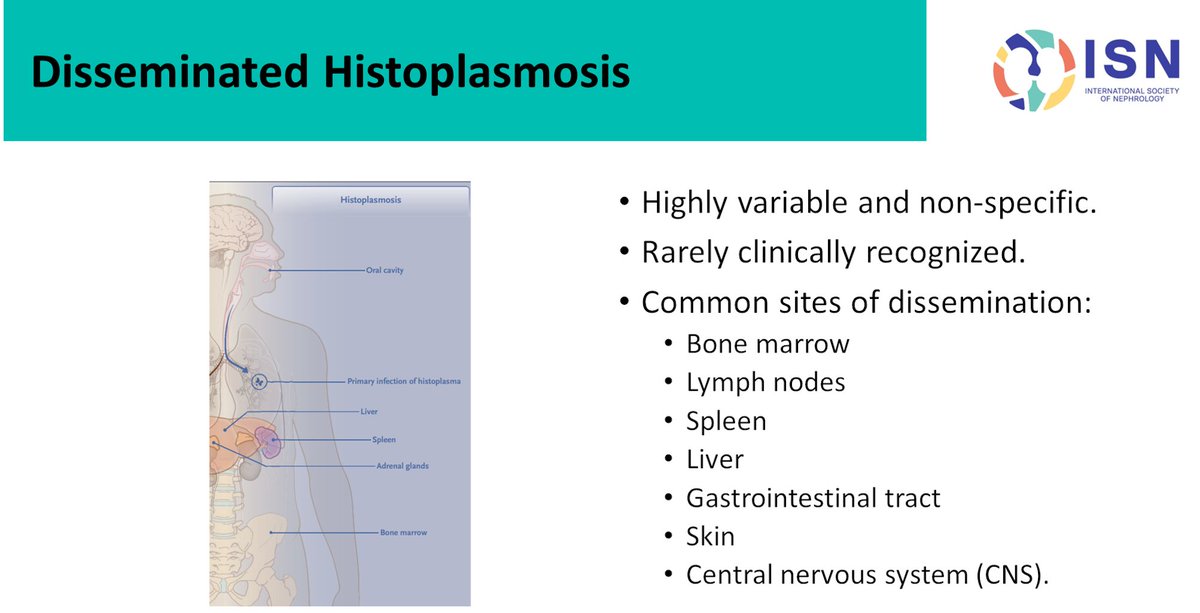 #ECNeph @ISNkidneycare @dra_miliflores @myadla
Clinical 📸 in this case ➡asthenia, adynamia, weight loss, gastrointestinal symptoms and splenomegaly (25-60% of cases).
If diagnosis is not consider, will usually be missed.
👉pubmed.ncbi.nlm.nih.gov/38324487/