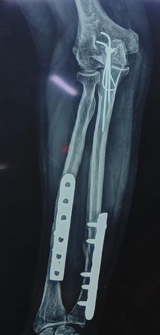 Bipin Theruvil FRCS (T&O),FRCS (Ed&Glasg),MS AIIMS tweet media