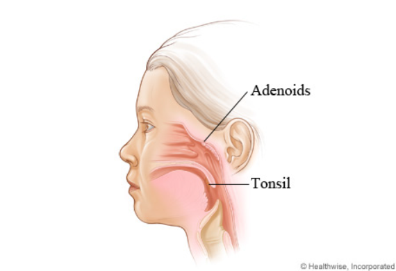 'Removing Children's Tonsils and Adenoids Increases Risk for 28 Diseases, Study Finds' 'We calculated disease risks depending on whether adenoids, tonsils, or both were removed in the first 9 years of life because this is when these tissues are most active in the developing