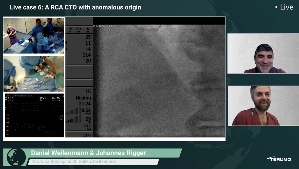 CTO LIVE AID (@cto_liveaid) on Twitter photo 🔥 #CTOLIVEAID2024: We are streaming live Slot 3 right now!
Join our panel to witness and comment on Live Case 5, focusing on “Post-CABG CTO PCI”, and Live Case 6, "An RCA CTO with Anomalous Origin."
Join us ➡️ swll.to/N14D7
#CTO #CharityEvent #Streaming #RCA #PCI 🔥 #CTOLIVEAID2024: We are streaming live Slot 3 right now!
Join our panel to witness and comment on Live Case 5, focusing on “Post-CABG CTO PCI”, and Live Case 6, "An RCA CTO with Anomalous Origin."
Join us ➡️ swll.to/N14D7
#CTO #CharityEvent #Streaming #RCA #PCI