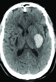 ross_prager's tweet photo. There are 3 life-threatening primary neurologic causes of sudden decreased LOC.. if you order the wrong test you might miss them 👇

1. Intracranial Bleed (SAH, ICH etc.)
2. Acute ischemic stroke (basilar / posterior)
3. Seizure

Any patient undergoing CT imaging for sudden decreased LOC should get a CT Angio

#medtwitter #foamed #neurotwitter #neurocrit