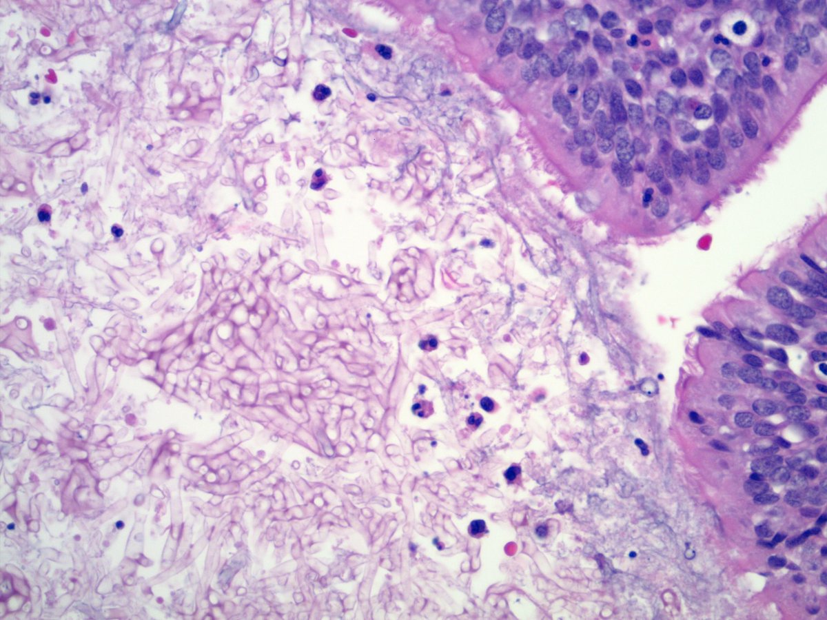An aspergilloma is a collection of Aspergillus fungal hyphae sitting within a dilated bronchial lumen. Does not invade tissue but can erode bronchus and cause hemoptysis. Also called fungus ball or mycetoma.

#Pathbugs #crittersontwitter #pathology #pulmpath