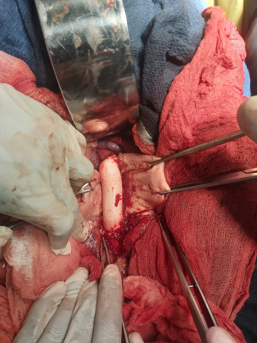 Dagim Leykun (@dagim_leykun) on Twitter photo Another case of AAA using a flexible clamp. Handy and efficient! Thank you, <a href="/gttefera/">Girma Tefera MD,FACS</a> for your generous donations and for making a difference in our work! Used cut pieces of Foley catheter as inserts.
<a href="/VascularForum/">Fórum Vascular</a> #aortaEd #Innovation Another case of AAA using a flexible clamp. Handy and efficient! Thank you, <a href="/gttefera/">Girma Tefera MD,FACS</a> for your generous donations and for making a difference in our work! Used cut pieces of Foley catheter as inserts.
<a href="/VascularForum/">Fórum Vascular</a> #aortaEd #Innovation